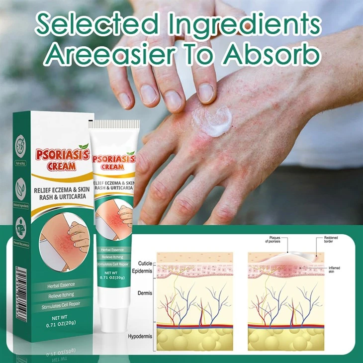 Dermatitis Pruritus Psoriasis Cream Ointment